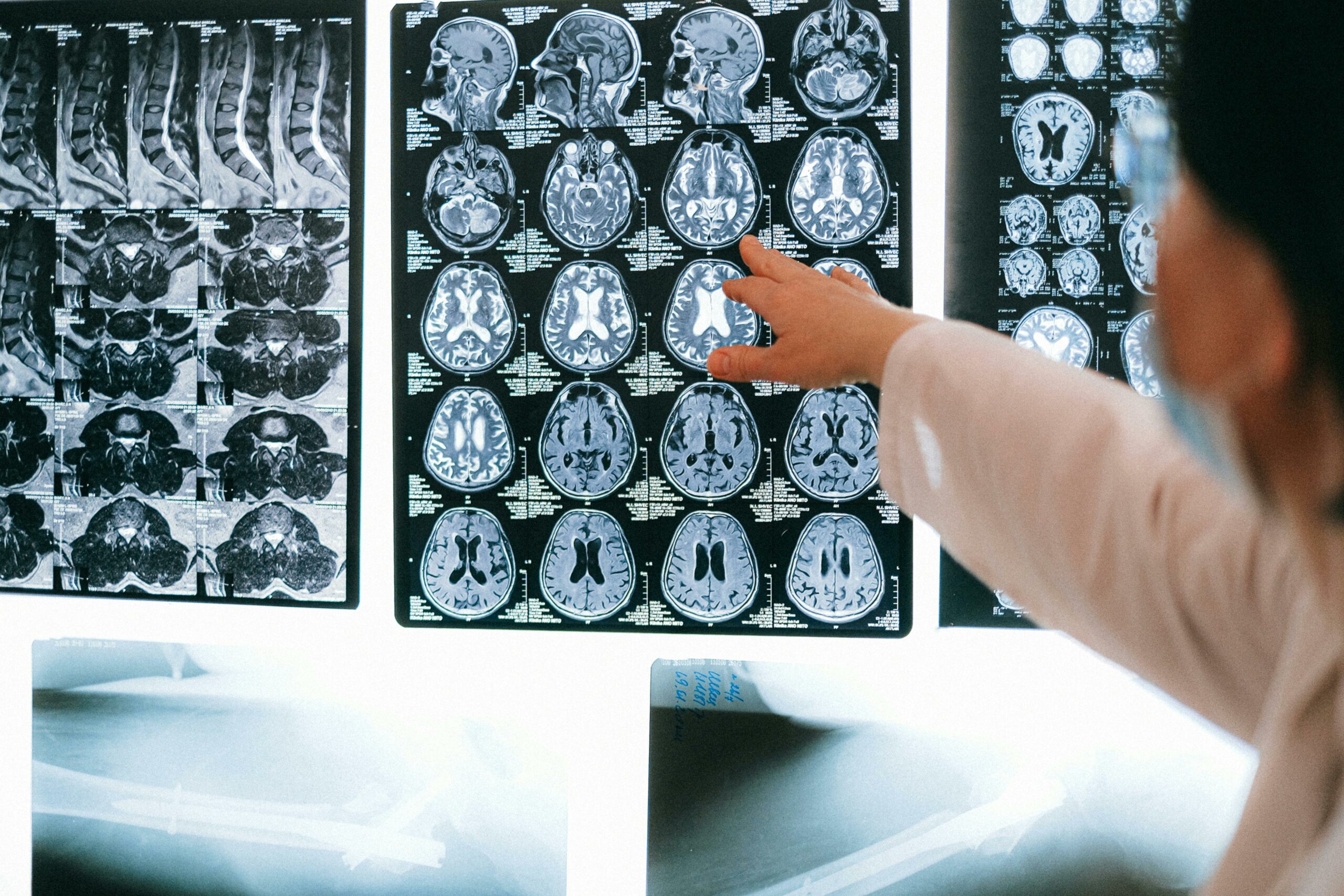 2025 年 HDBuzz 奖:磁共振——“为什么”我有这种感觉?核磁共振成像(MRI)如何帮助我们理解为什么亨廷顿病患者有时会察觉不到自己的症状